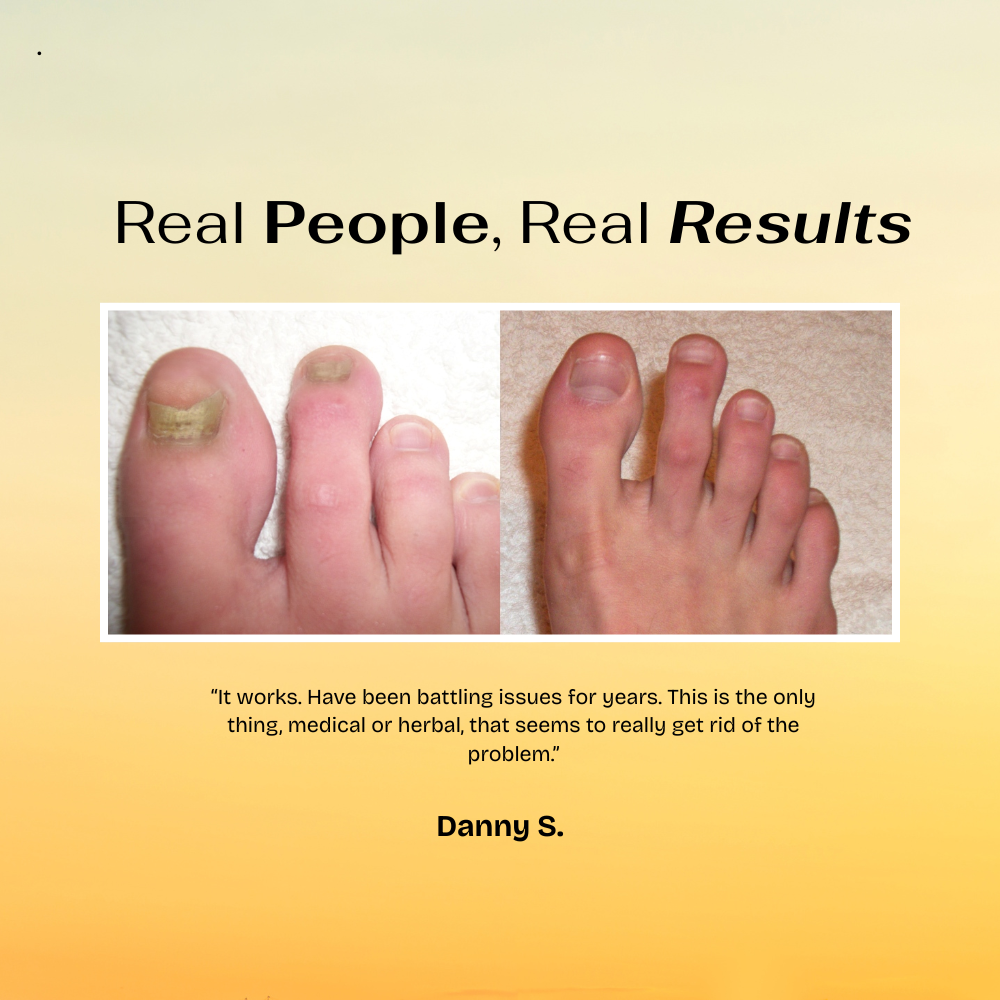 GoldenRoot™ Nail Treatment